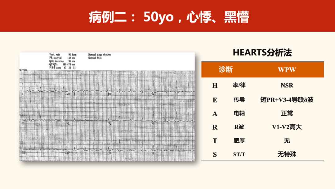 如何掌握V1导联高R波的心电图诊断？