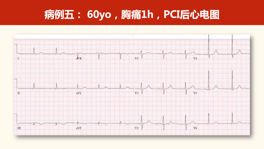 如何掌握V1导联高R波的心电图诊断？