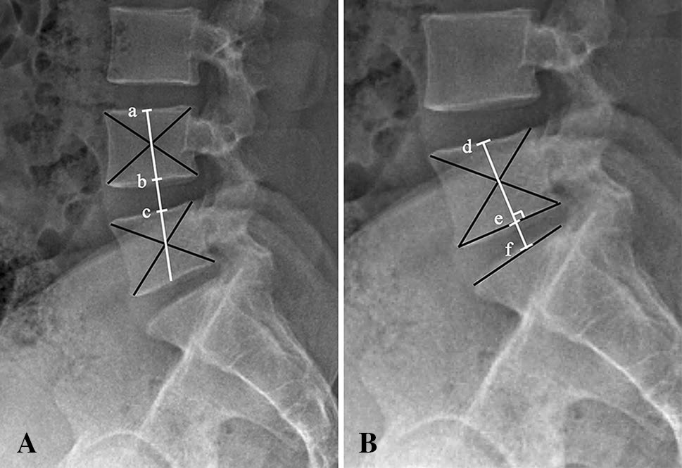 椎间孔镜术后复发性腰椎间盘突出的影像学危险因素