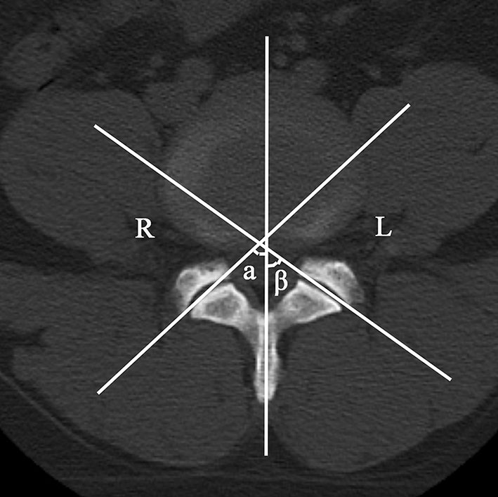 椎间孔镜术后复发性腰椎间盘突出的影像学危险因素