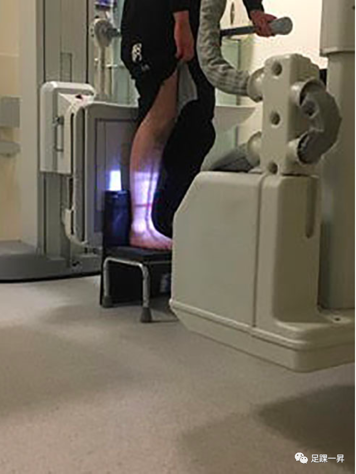 踝关节骨折：负重位X线VS重力应力试验VS手法应力试验哪个更靠谱？