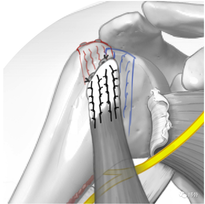 背阔肌转位用于治疗不可修复性肩胛下肌腱撕裂