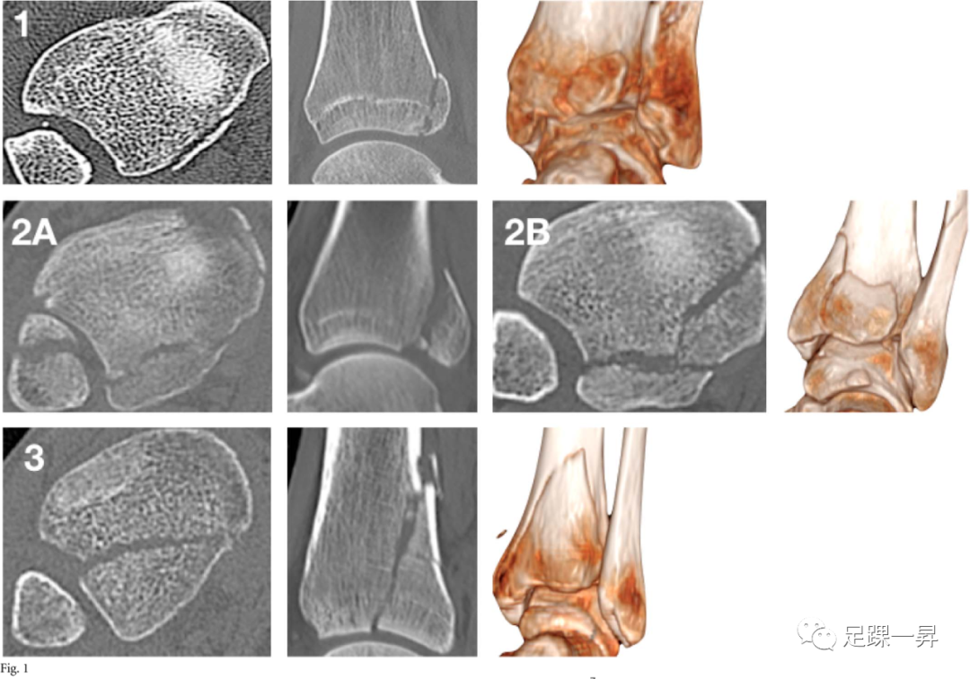 后踝骨折：最新分型以及夹层骨块分布