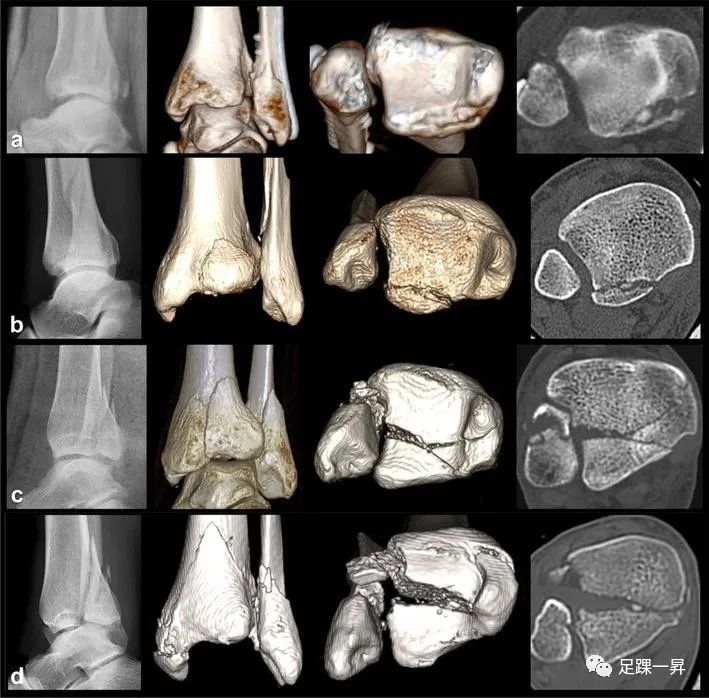 后踝骨折：最新分型以及夹层骨块分布