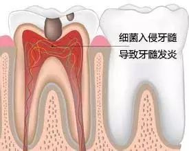 不同类型牙痛的用药技巧