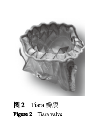 【综述】经导管二尖瓣置换技术难点概述