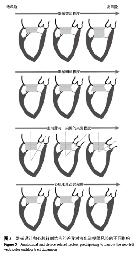 【综述】经导管二尖瓣置换技术难点概述