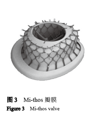 【综述】经导管二尖瓣置换技术难点概述