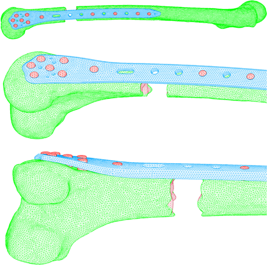 钢板尺寸和螺钉分布对股骨远端骨折生物力学的影响