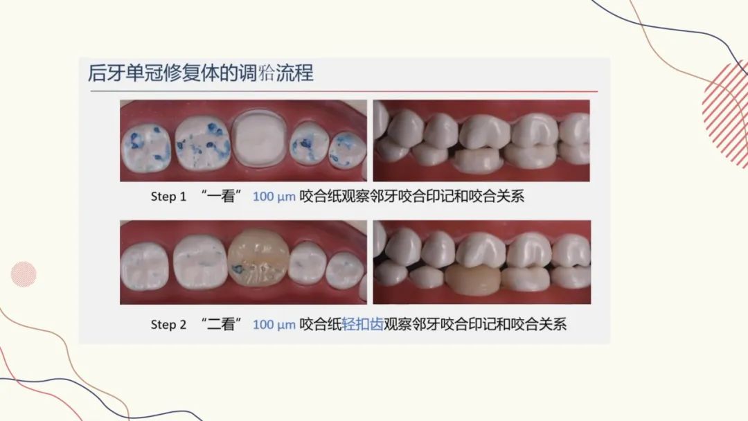 咬合纸的临床应用