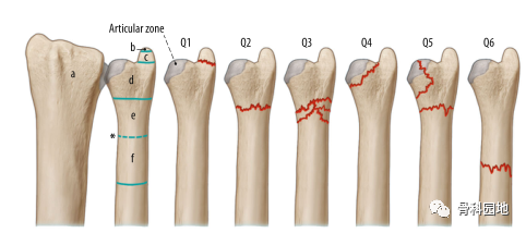 一组精美图片介绍尺骨远端骨折的手术治疗