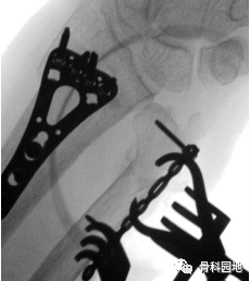 一组精美图片介绍尺骨远端骨折的手术治疗