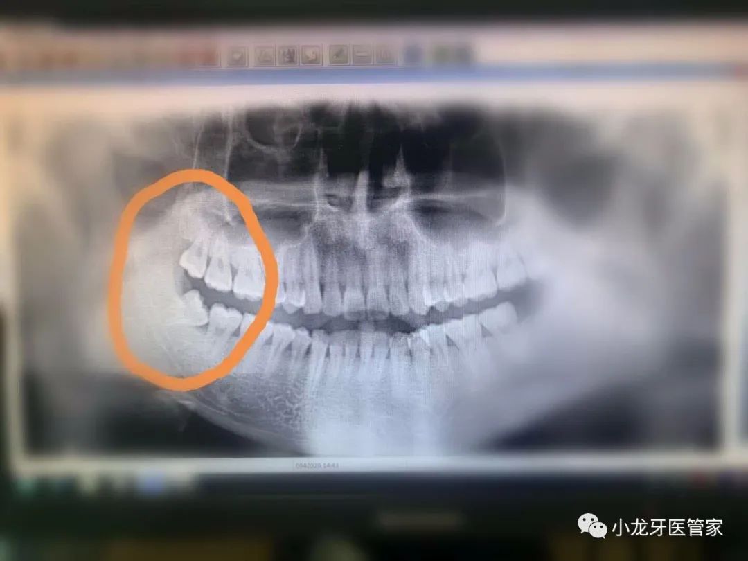 为什么要拔智齿，拔牙前后要注意什么？