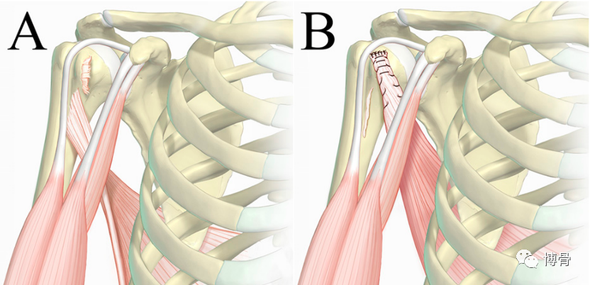 不可修复性肩袖撕裂的手术治疗方式