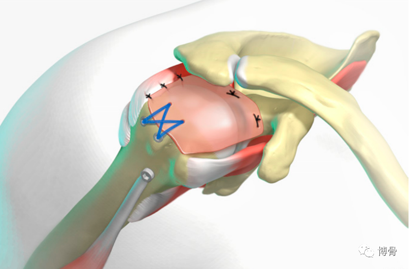 不可修复性肩袖撕裂的手术治疗方式