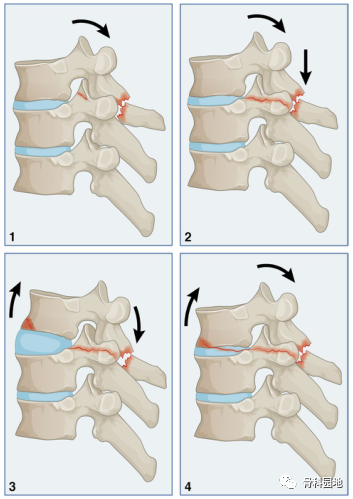 胸椎骨折的四柱理论，根据分类情况提出治疗建议