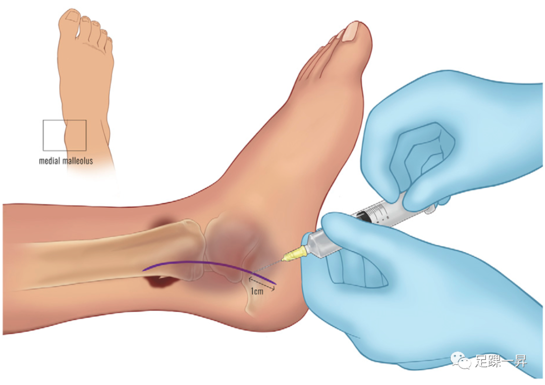 足踝部（WALANT）完全清醒局麻下无止血带技术应用