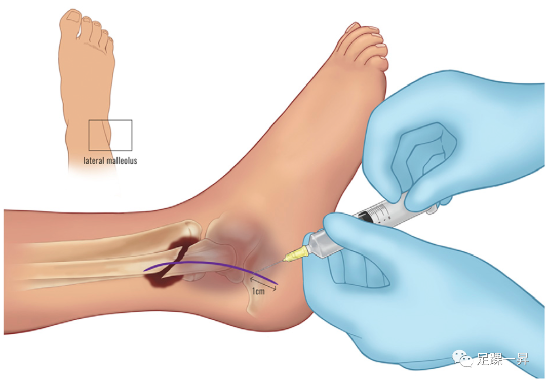 足踝部（WALANT）完全清醒局麻下无止血带技术应用