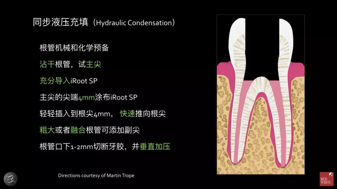 三种根充材料临床使用效果对比，你常用的是哪种？