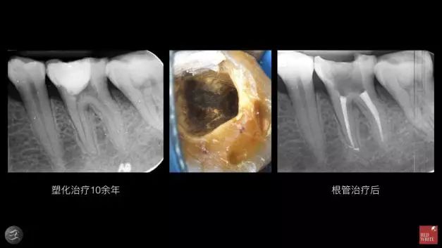 三种根充材料临床使用效果对比，你常用的是哪种？