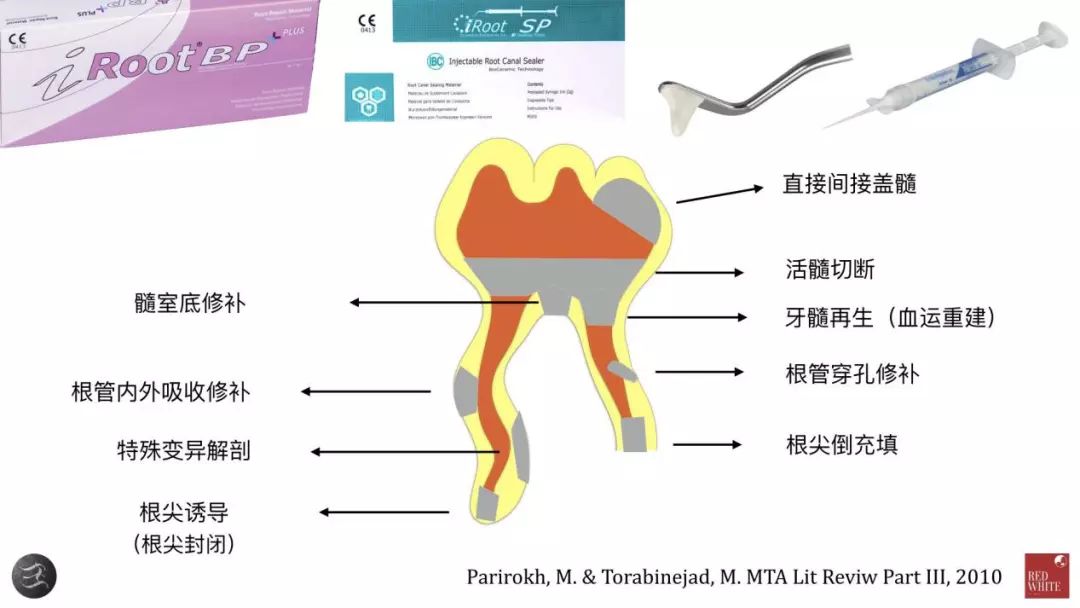 三种根充材料临床使用效果对比，你常用的是哪种？