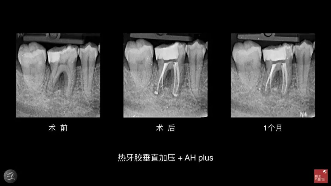 三种根充材料临床使用效果对比，你常用的是哪种？