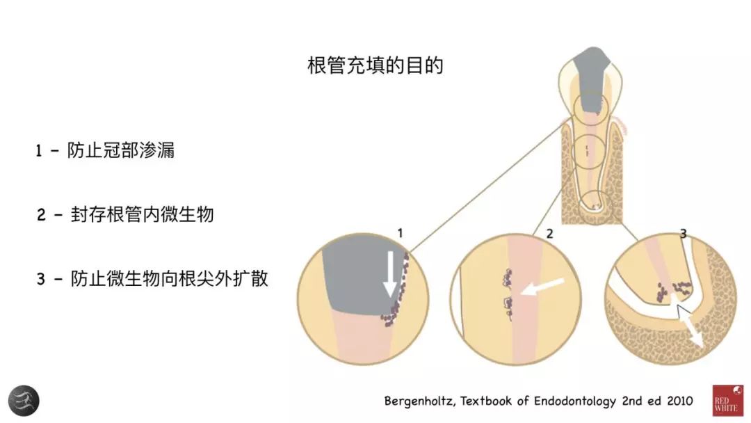 三种根充材料临床使用效果对比，你常用的是哪种？