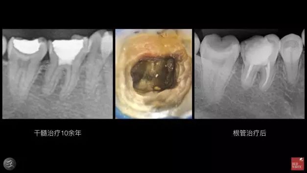 三种根充材料临床使用效果对比，你常用的是哪种？