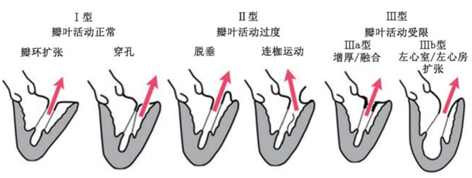 一表掌握！急性和慢性二尖瓣反流的临床表现差异