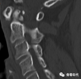 着急的皇冠-齿状突加冠综合征