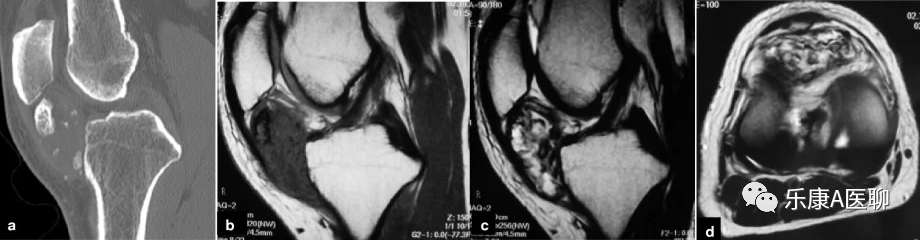 【病案分享】关节镜下切除髌下脂肪垫多发骨化瘤