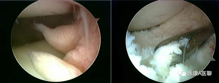【病案分享】关节镜下切除髌下脂肪垫多发骨化瘤
