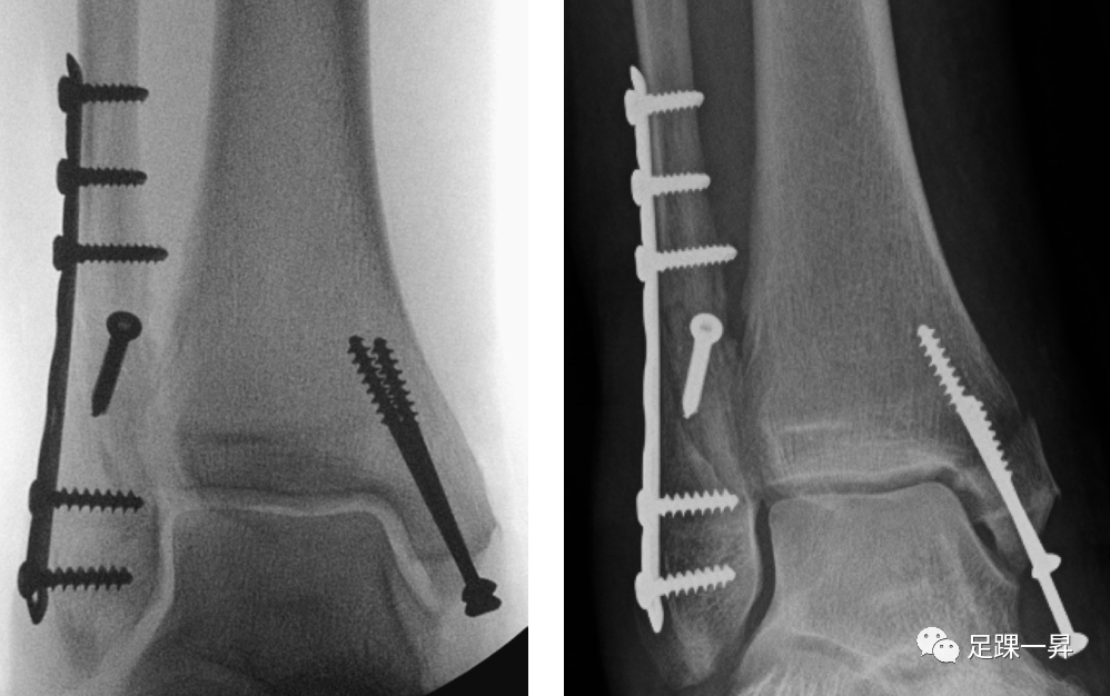 内踝骨折最新分型以及内固定方式