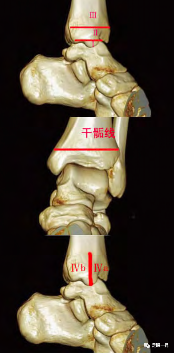 内踝骨折最新分型以及内固定方式