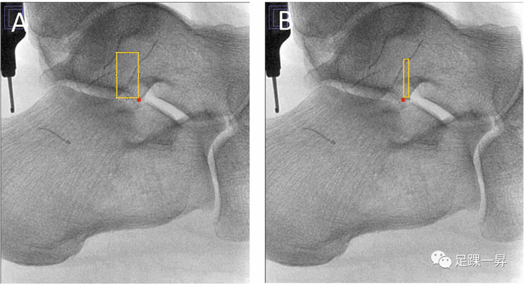 【足踝解剖】踝关节外侧韧带复合体的X线解剖学研究