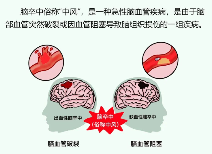 【干货分享】脑卒中患者如何进行快速急救处理？