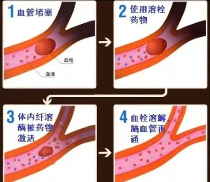 【干货分享】脑卒中患者如何进行快速急救处理？