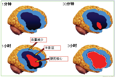 【干货分享】脑卒中患者如何进行快速急救处理？