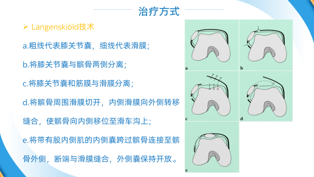 股四头肌成形术（Green术）治疗儿童先天性/习惯性髌骨脱位