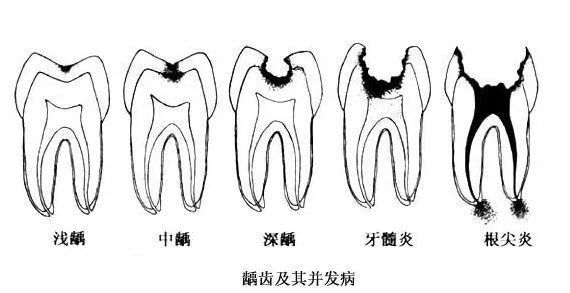 牙齿都烂了一半，为何不能直接补牙？