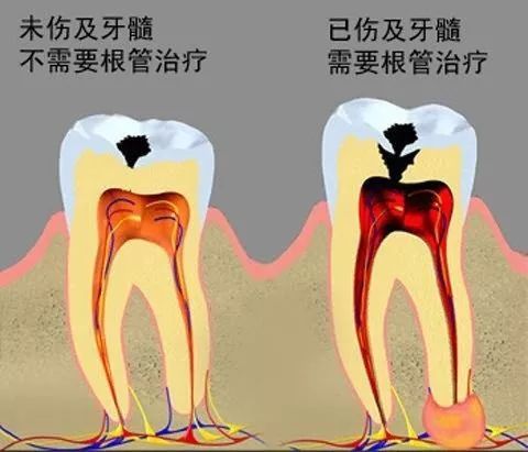 牙齿都烂了一半，为何不能直接补牙？