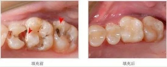 牙齿都烂了一半，为何不能直接补牙？