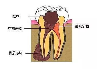 牙齿都烂了一半，为何不能直接补牙？