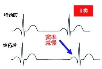 常用心律失常药物对心电图的影响