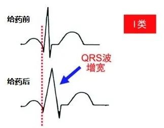 常用心律失常药物对心电图的影响