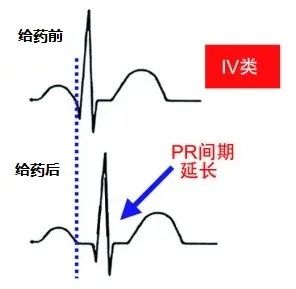 常用心律失常药物对心电图的影响