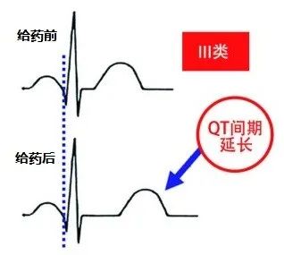 常用心律失常药物对心电图的影响