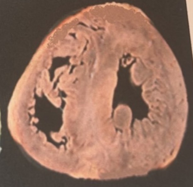 肥厚型心肌病简介及临床试验