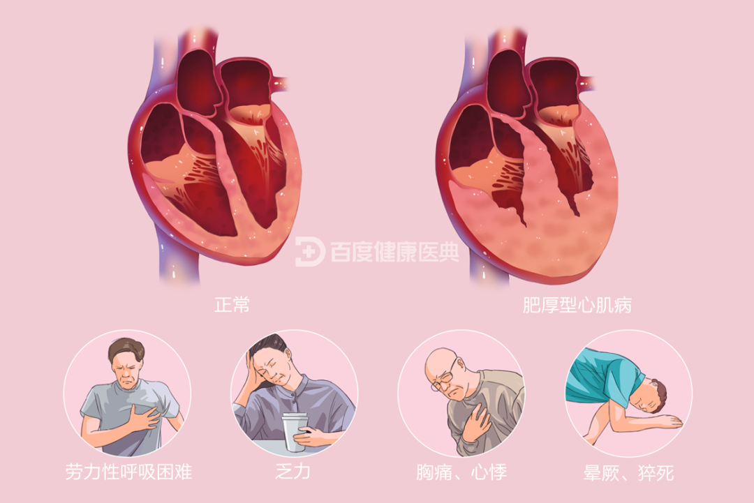 肥厚型心肌病简介及临床试验