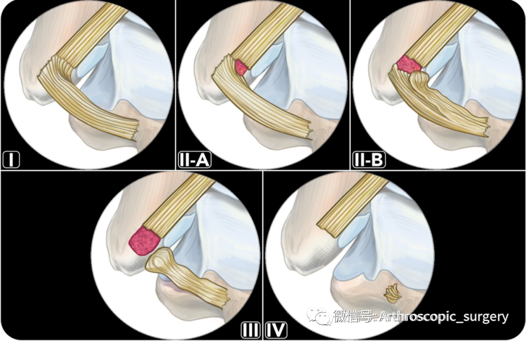 【手术理念】距腓前韧带损伤怎样查体最有效？